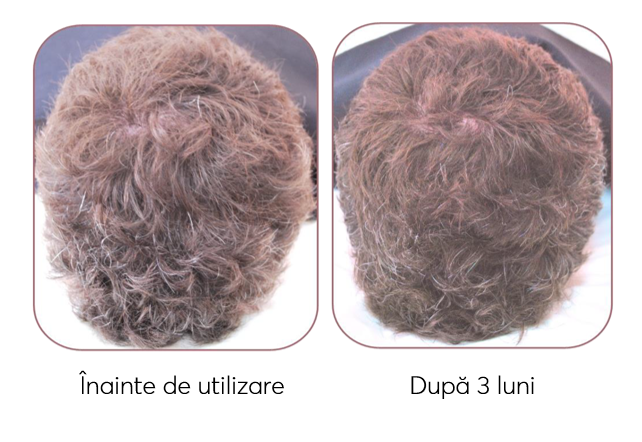 Trial kit, Travel Size tratament impotriva incaruntirii si caderii parului, Ageless Clinic, 3 bucati, Rut Hair, 80 ml - imagine 6