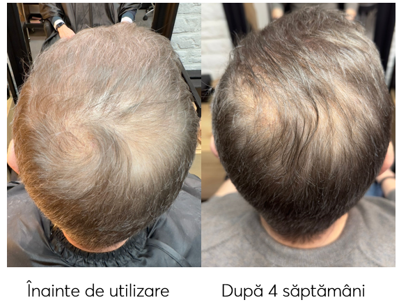 Trial kit, Travel Size tratament impotriva incaruntirii si caderii parului, Ageless Clinic, 3 bucati, Rut Hair, 80 ml - imagine 7